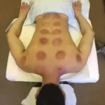 cupping therapy marks