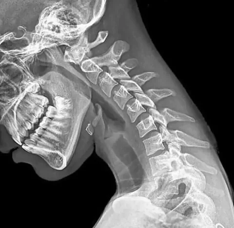 teen's neck x-ray